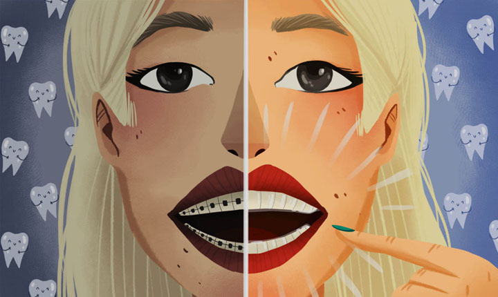 Resiko Pasang Behel Gigi