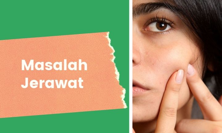 Mencegah Jerawat Muncul