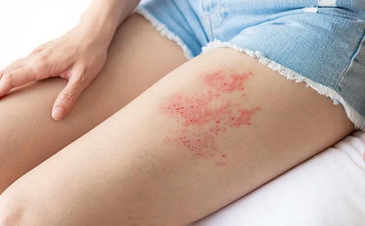 Mengenal Lebih Dekat Dengan Virus Herpes Dan Pencegahannya